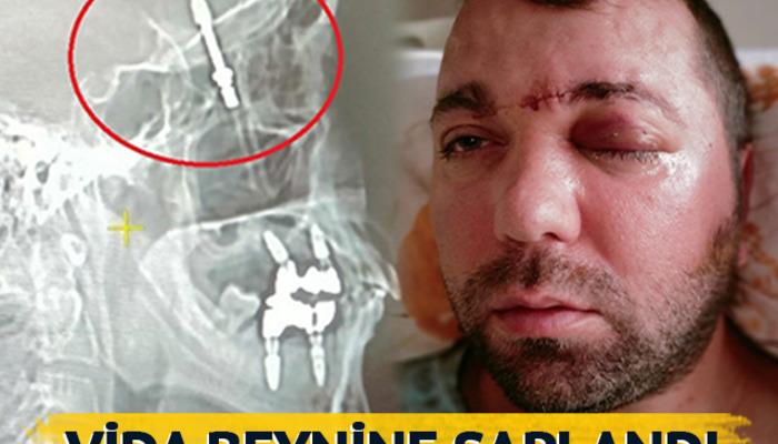 İmplant tedavisi sırasında vida beynine saplandı... Doktorlar gözlerine inanamadı!  "Bana hayatımı kaybedebileceğimi söylediler" Konuşması Amerika'daki dergilere konu oldu